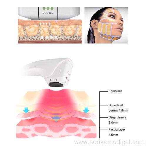 Portable 3d anti-aging hifu machine